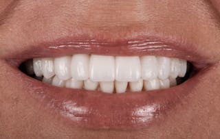 Full Mouth Restoration Before & After Gallery - Patient 410825 - Image 2