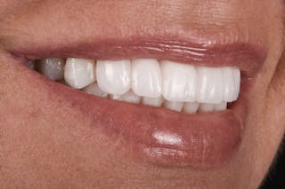 Full Mouth Restoration Before & After Gallery - Patient 410825 - Image 4