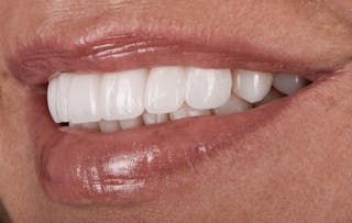 Full Mouth Restoration Before & After Gallery - Patient 410825 - Image 6