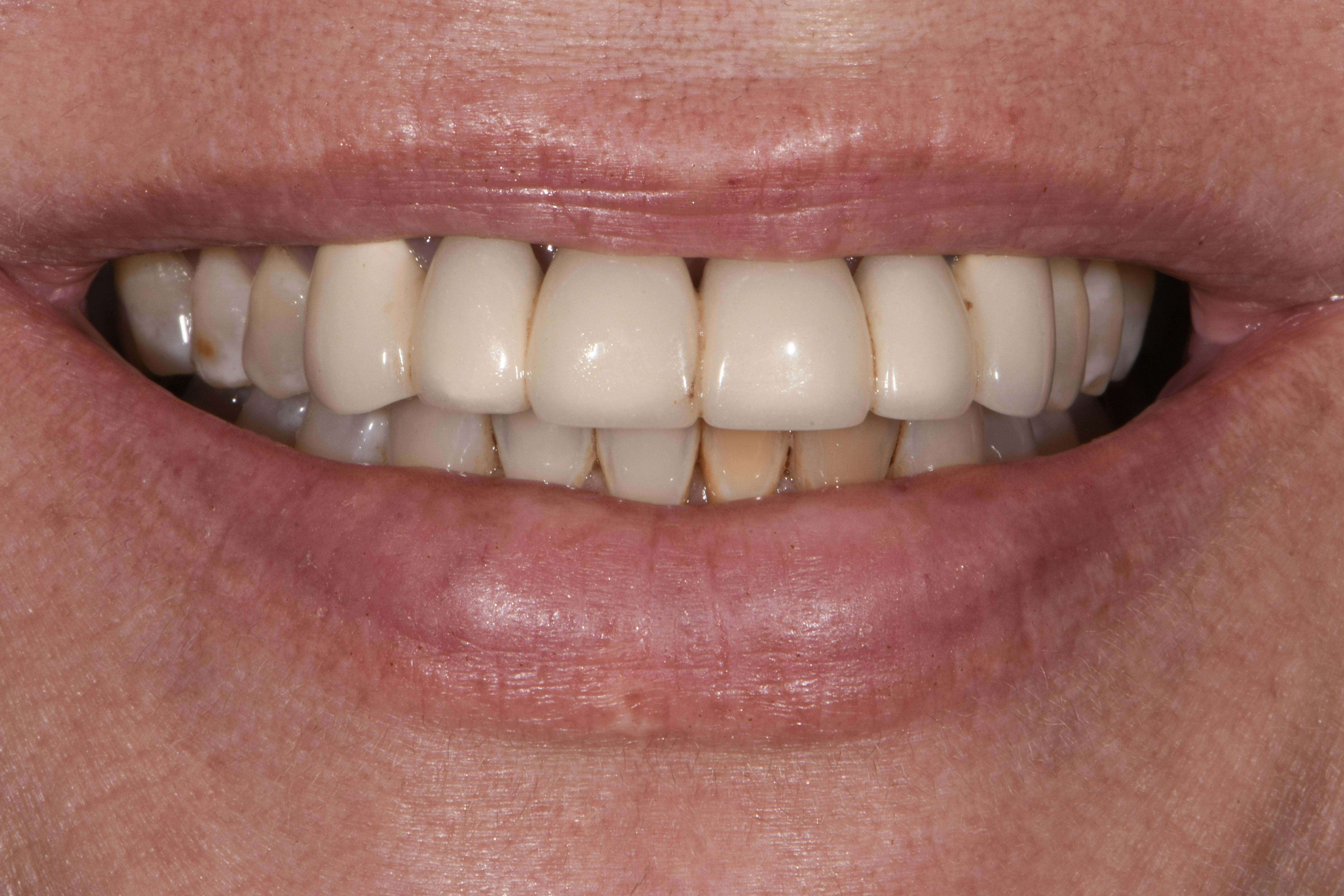 Before & After Photos | Charleston Center for Cosmetic and Restorative Dentistry - Full Mouth Restoration - Patient 6 - Before Procedure