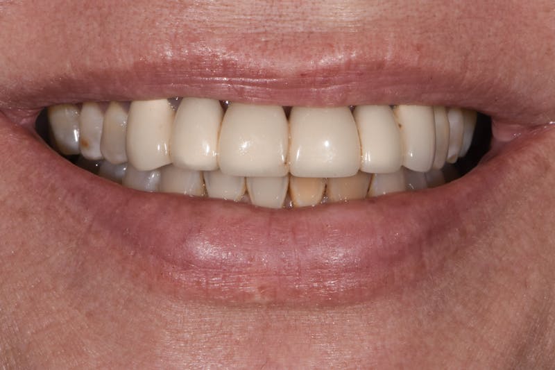 Full Mouth Restoration Before & After Gallery - Patient 410825 - Image 1