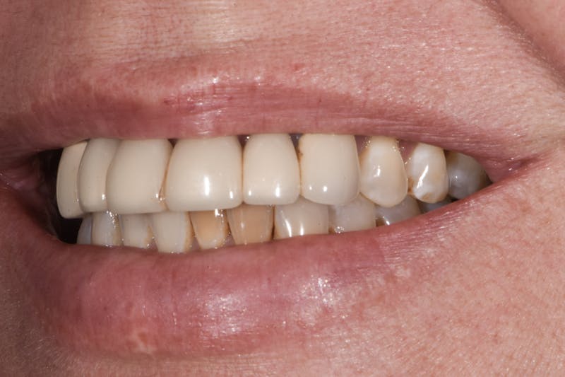 Full Mouth Restoration Before & After Gallery - Patient 410825 - Image 5
