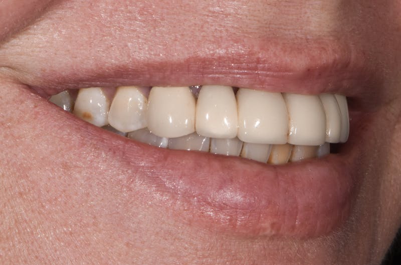 Full Mouth Restoration Before & After Gallery - Patient 410825 - Image 3