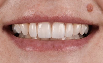 Full Mouth Restoration Before & After Gallery - Patient 159035 - Image 2