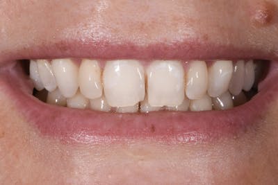 Full Mouth Restoration Before & After Gallery - Patient 159035 - Image 1