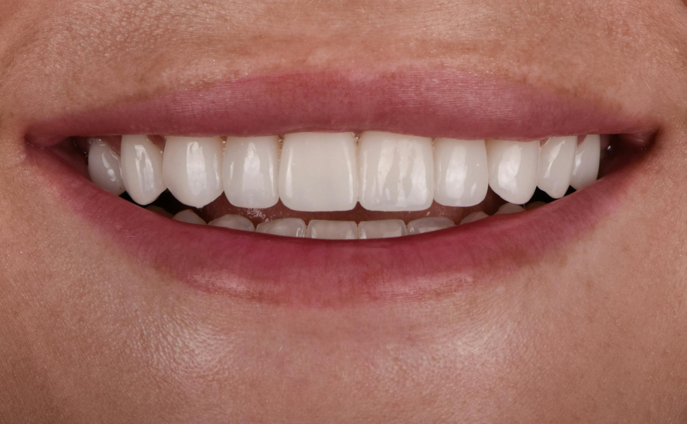 Full Mouth Restoration Before & After Gallery - Patient 194760 - Image 2
