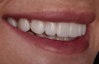 Full Mouth Restoration Before & After Gallery - Patient 194760 - Image 4