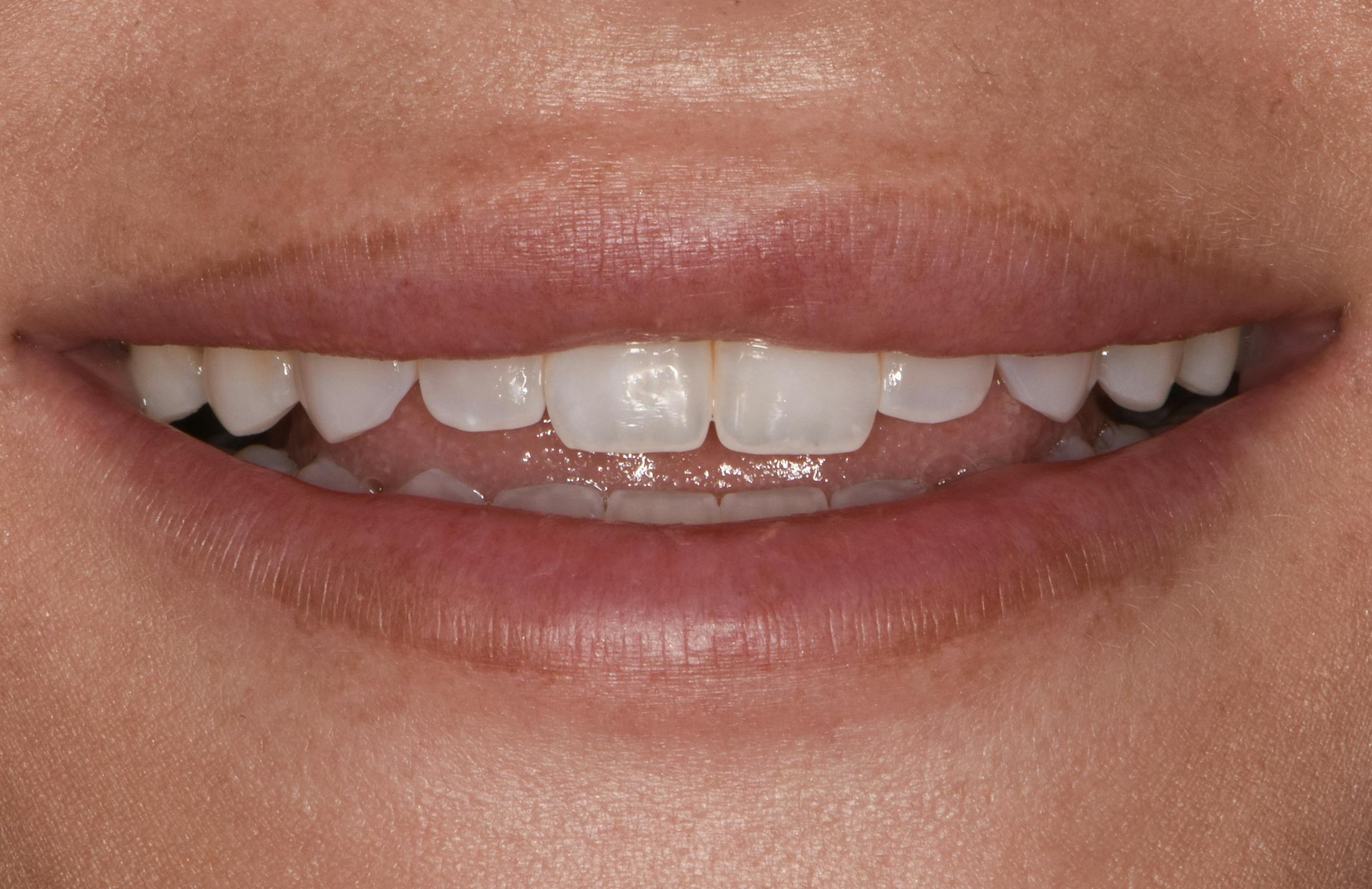 Full Mouth Restoration Before & After Gallery - Patient 194760 - Image 1