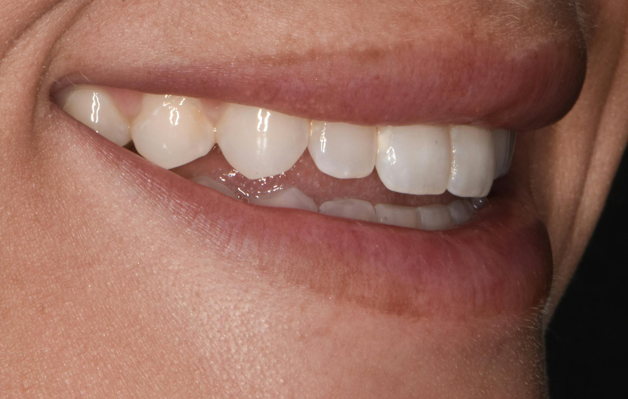 Full Mouth Restoration Before & After Gallery - Patient 194760 - Image 3