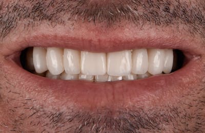 Porcelain Veneers Before & After Gallery - Patient 124276 - Image 2