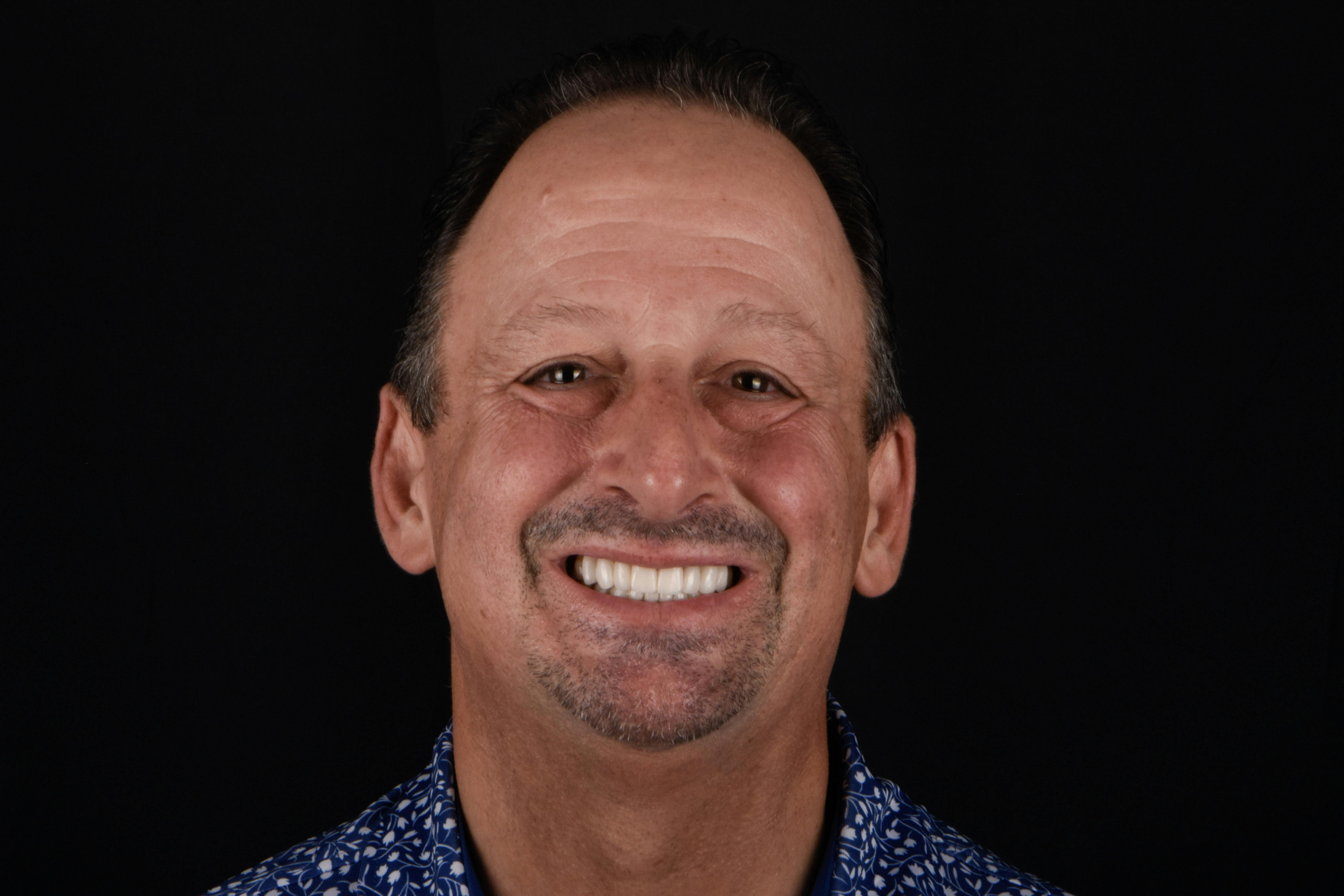 Porcelain Veneers Before & After Gallery - Patient 124276 - Image 1