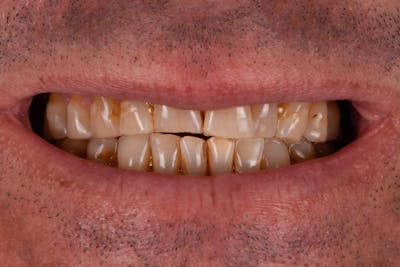 Porcelain Veneers Before & After Gallery - Patient 124276 - Image 1