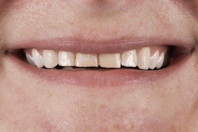 Prep-less Veneers Before & After Gallery - Patient 296786 - Image 1