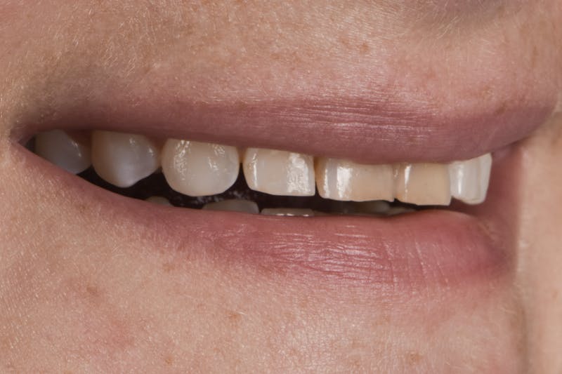 Prep-less Veneers Before & After Gallery - Patient 296786 - Image 3