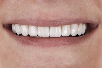 Prep-less Veneers Before & After Gallery - Patient 296786 - Image 2