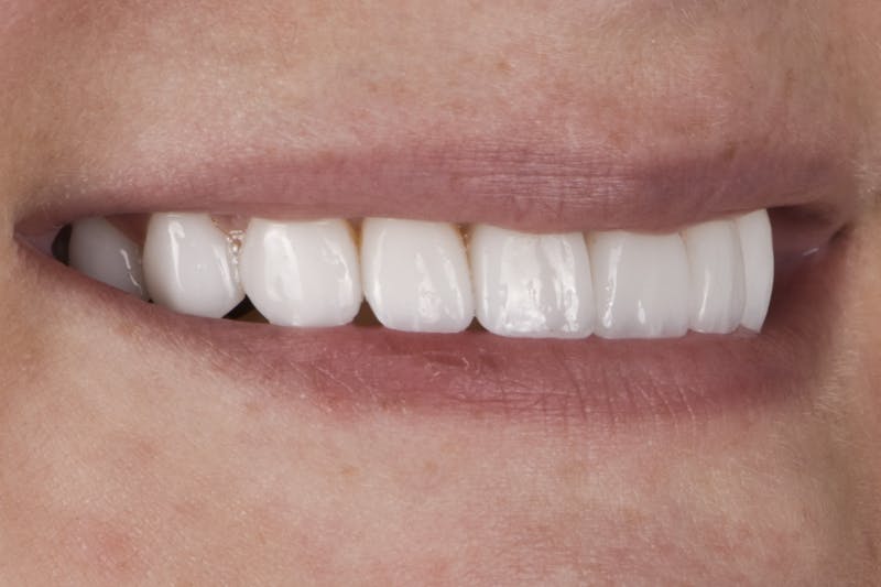 Prep-less Veneers Before & After Gallery - Patient 296786 - Image 4