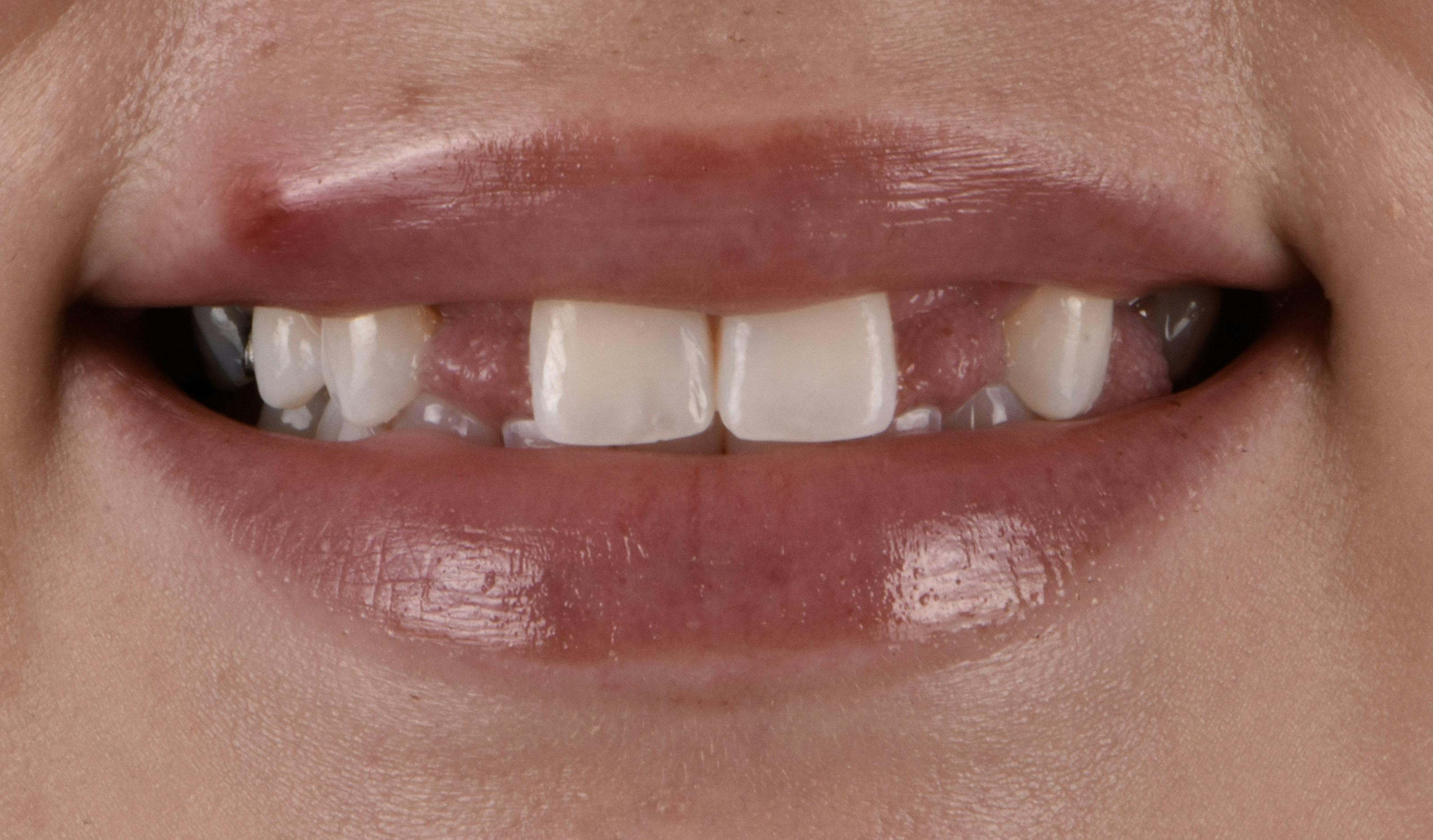 Before & After Photos | Charleston Center for Cosmetic and Restorative Dentistry - Full Mouth Restoration - Patient 3 - Before Procedure