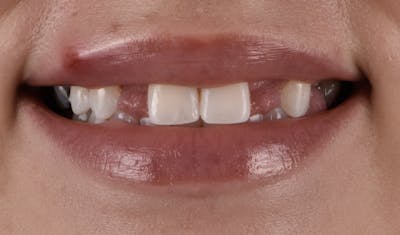 Full Mouth Restoration Before & After Gallery - Patient 141270 - Image 1