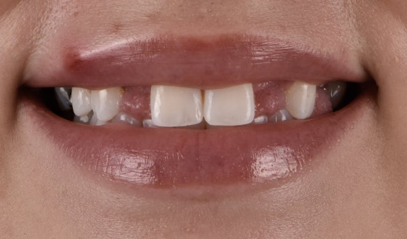 Full Mouth Restoration Before & After Gallery - Patient 141270 - Image 1