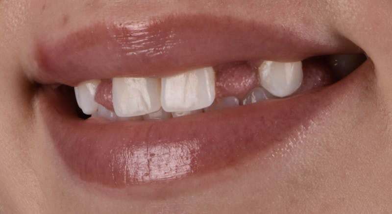 Full Mouth Restoration Before & After Gallery - Patient 141270 - Image 5
