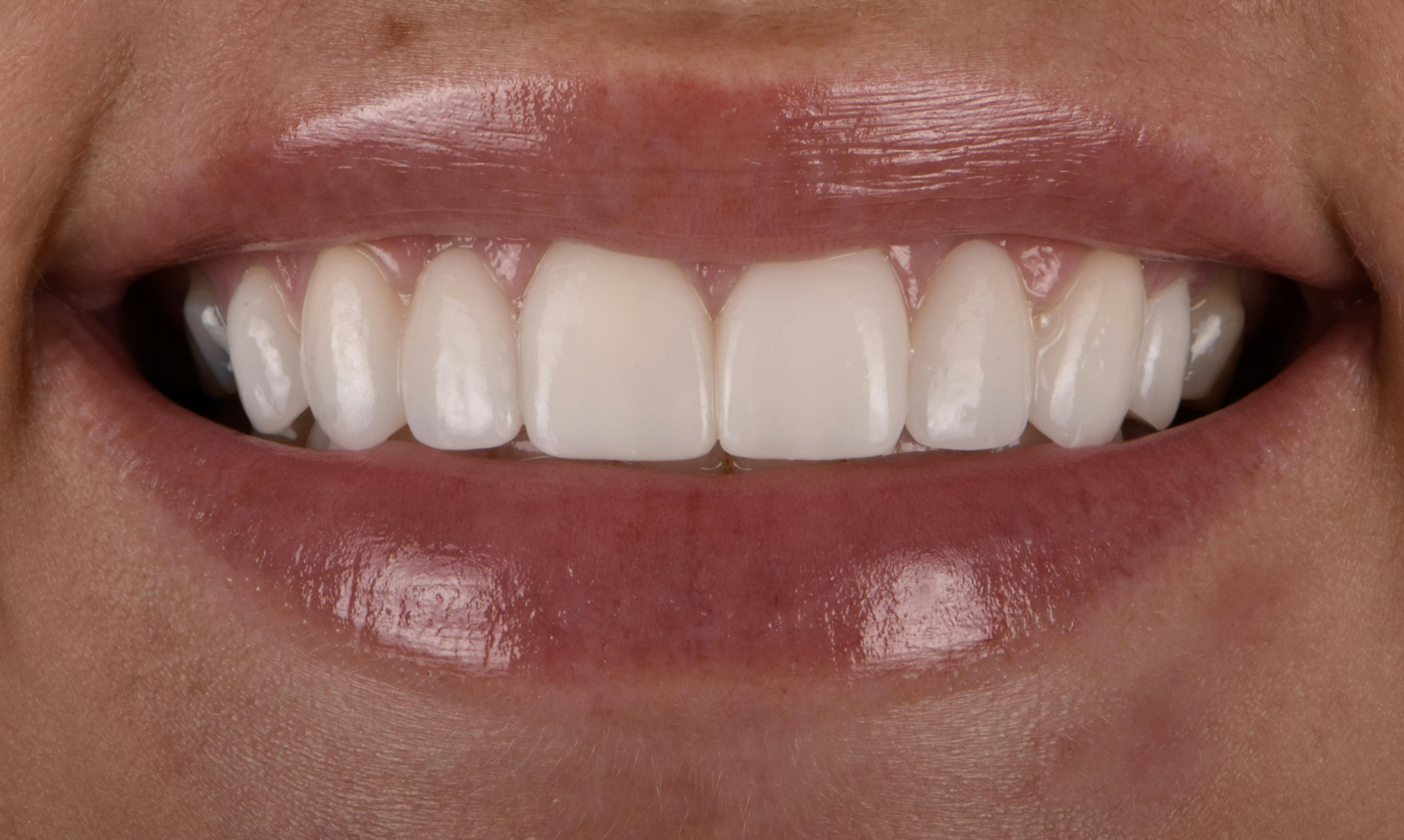 Before & After Photos | Charleston Center for Cosmetic and Restorative Dentistry - Full Mouth Restoration - Patient 3 - After Procedure