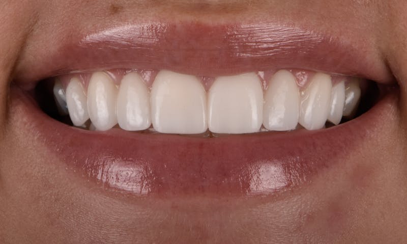 Full Mouth Restoration Before & After Gallery - Patient 141270 - Image 2