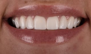Full Mouth Restoration Before & After Gallery - Patient 141270 - Image 2