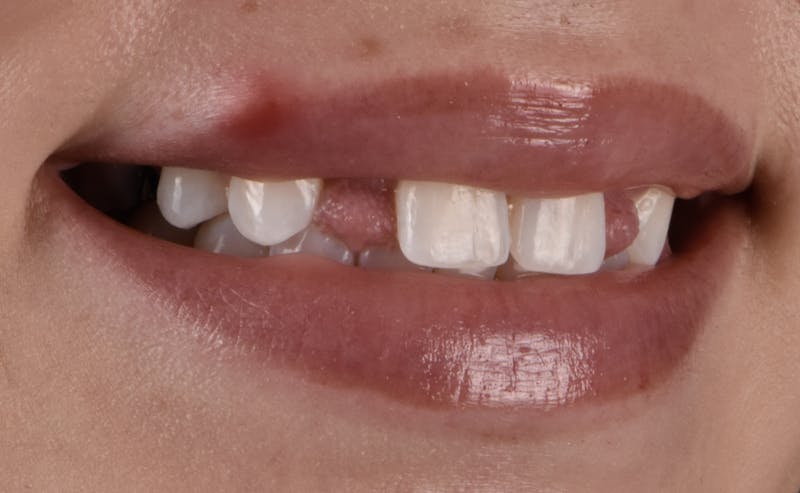 Full Mouth Restoration Before & After Gallery - Patient 141270 - Image 3