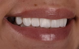 Full Mouth Restoration Before & After Gallery - Patient 141270 - Image 4