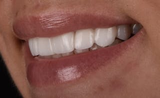 Full Mouth Restoration Before & After Gallery - Patient 141270 - Image 6