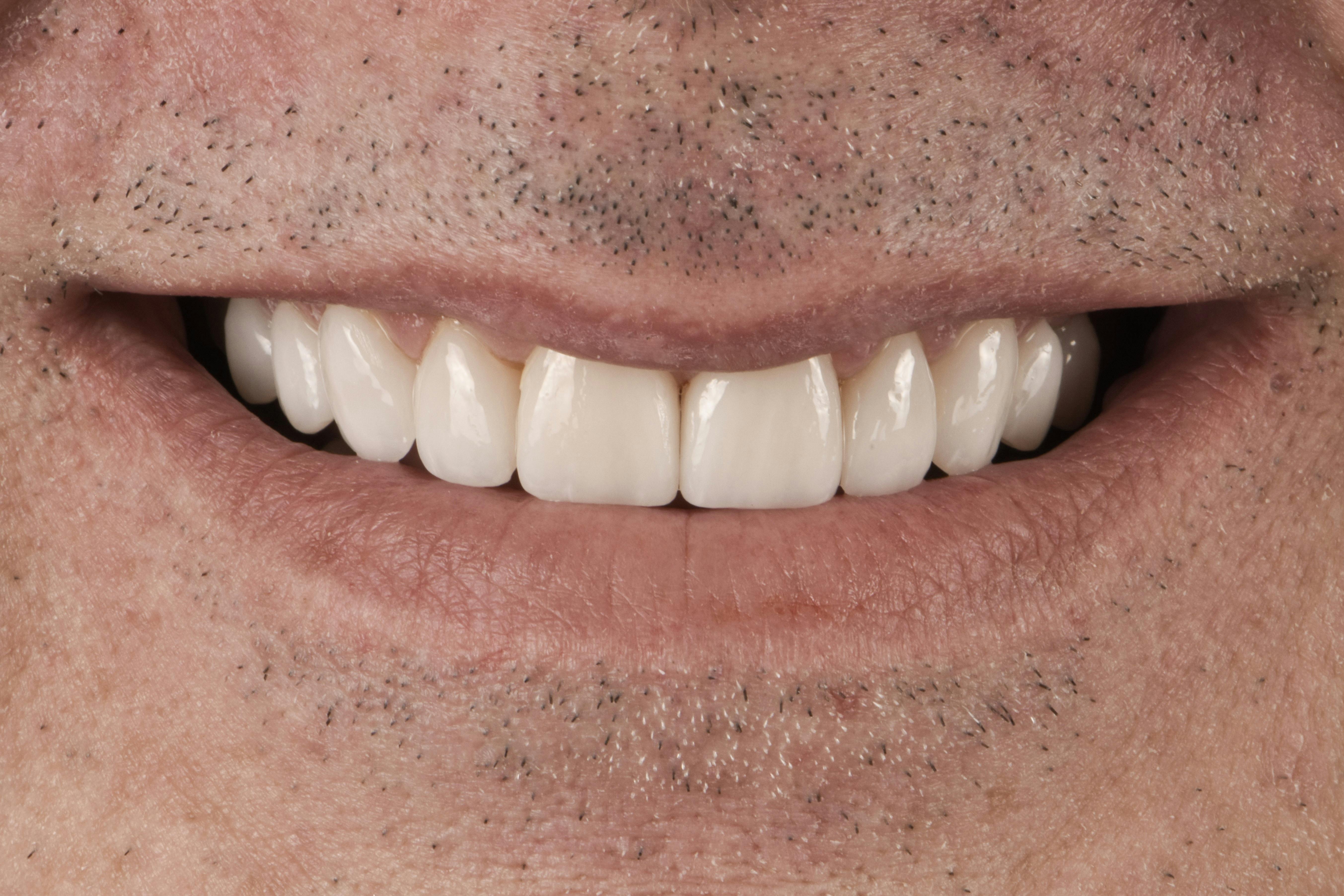 Before & After Photos | Charleston Center for Cosmetic and Restorative Dentistry - Full Mouth Restoration - Patient 2 - After Procedure