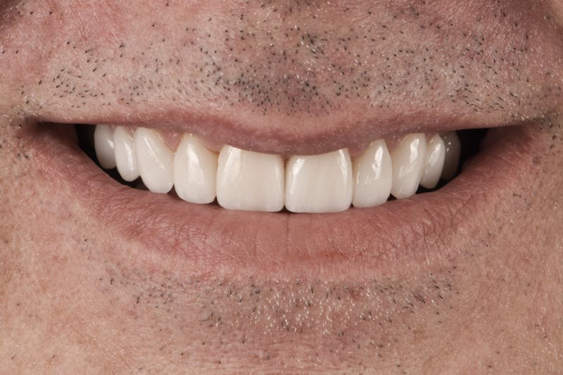 Full Mouth Restoration Before & After Gallery - Patient 296712 - Image 2