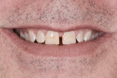 Full Mouth Restoration Before & After Gallery - Patient 296712 - Image 1