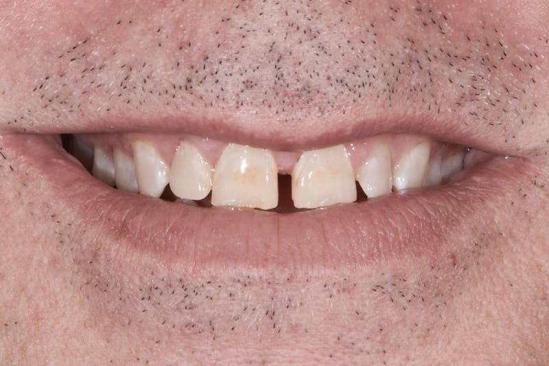 Full Mouth Restoration Before & After Gallery - Patient 296712 - Image 1