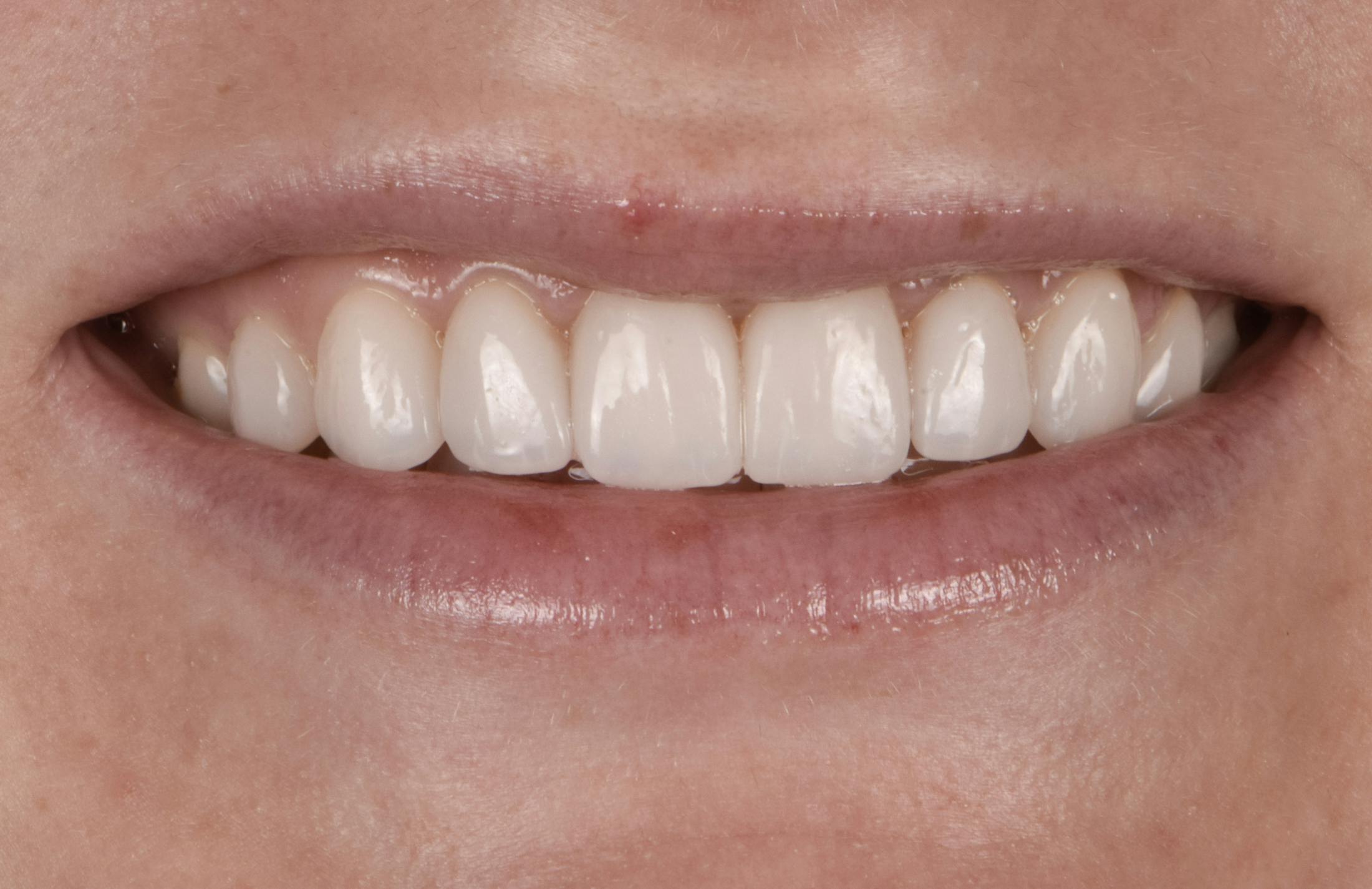 Prep-less Veneers Before & After Gallery - Patient 131079 - Image 2