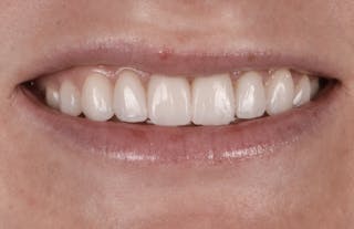 Prep-less Veneers Before & After Gallery - Patient 131079 - Image 2