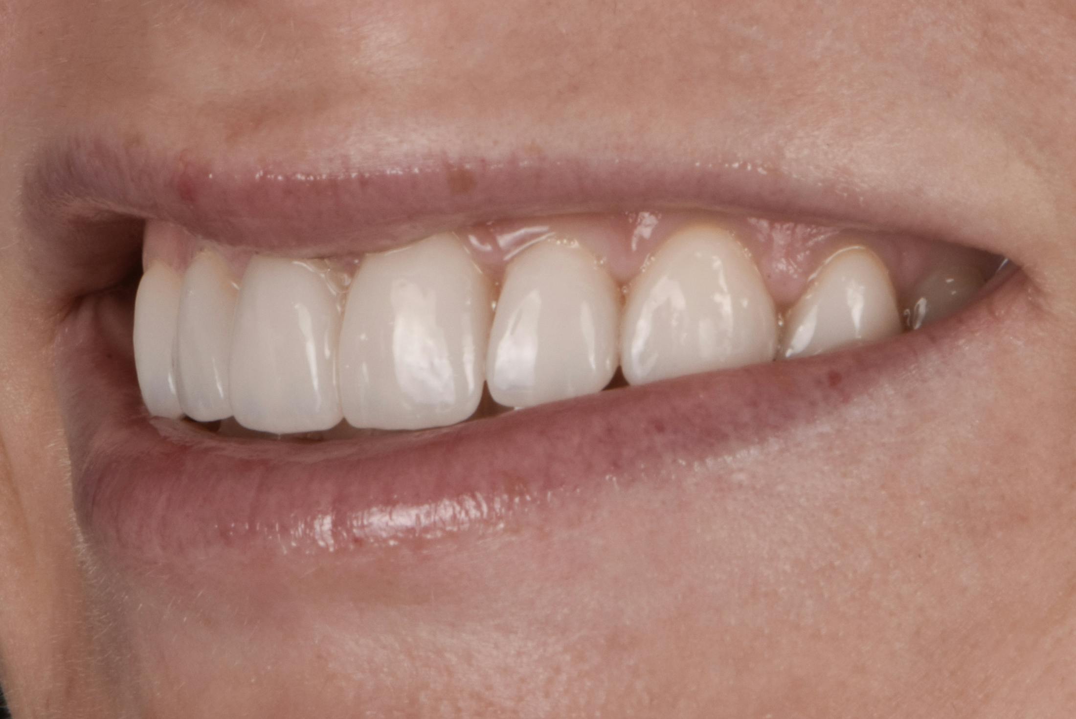 Prep-less Veneers Before & After Gallery - Patient 131079 - Image 4