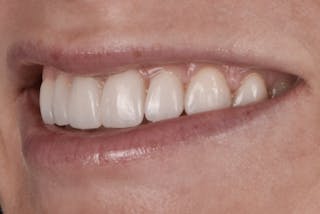 Prep-less Veneers Before & After Gallery - Patient 131079 - Image 4