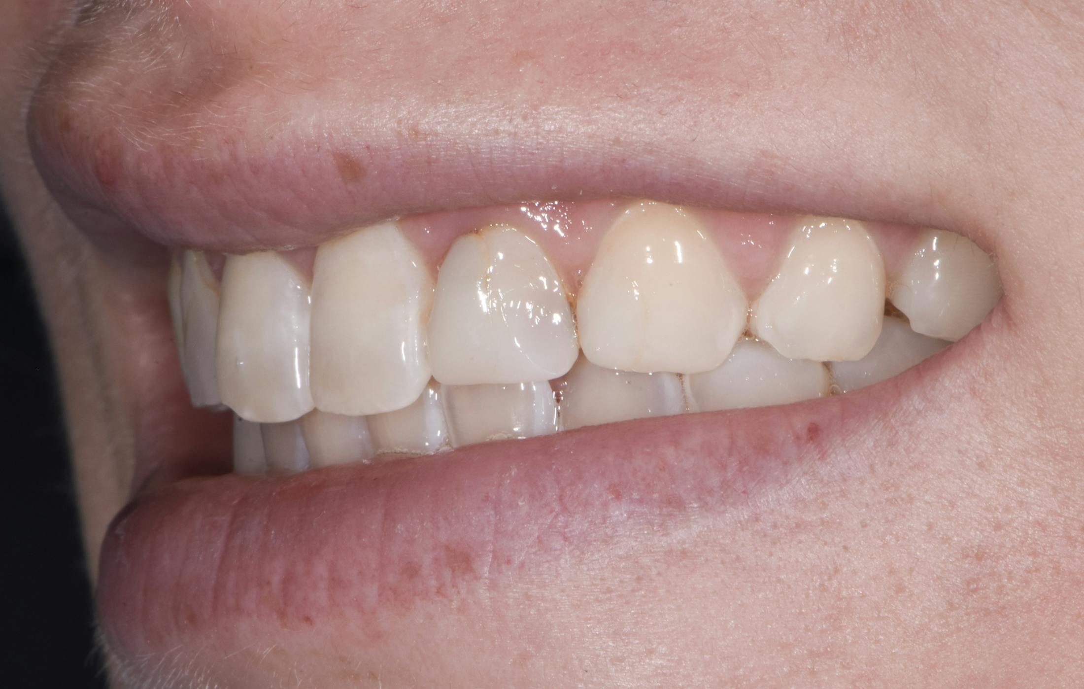 Prep-less Veneers Before & After Gallery - Patient 131079 - Image 3