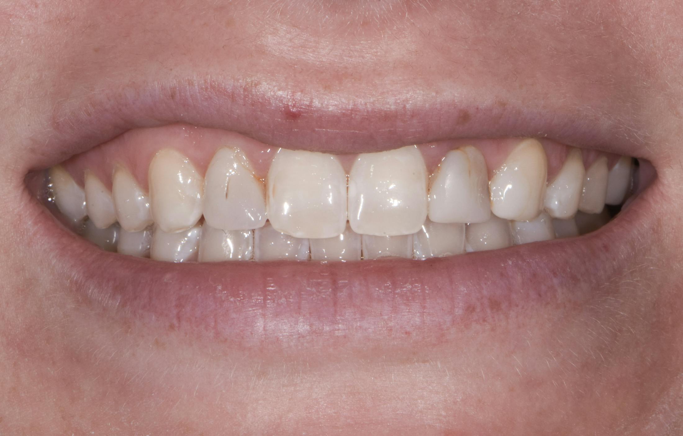 Prep-less Veneers Before & After Gallery - Patient 131079 - Image 1