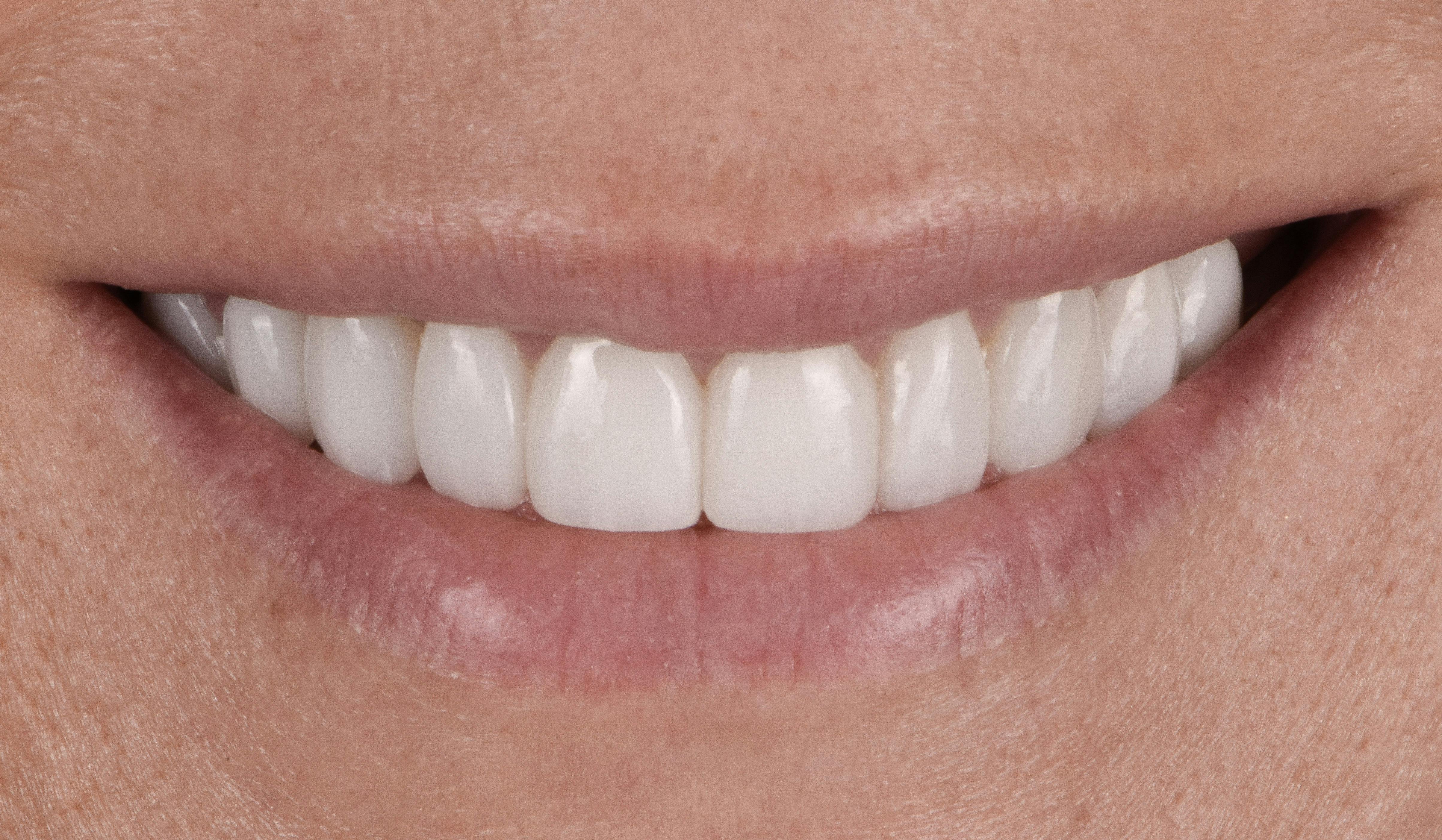 Before & After Photos | Charleston Center for Cosmetic and Restorative Dentistry - Bridges - Patient 1 - After Procedure