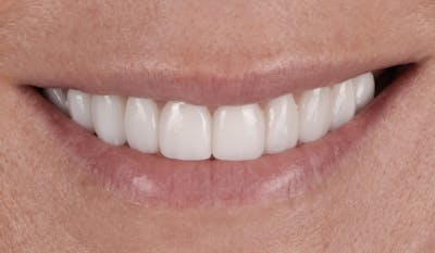 Porcelain Veneers Before & After Gallery - Patient 141772 - Image 2