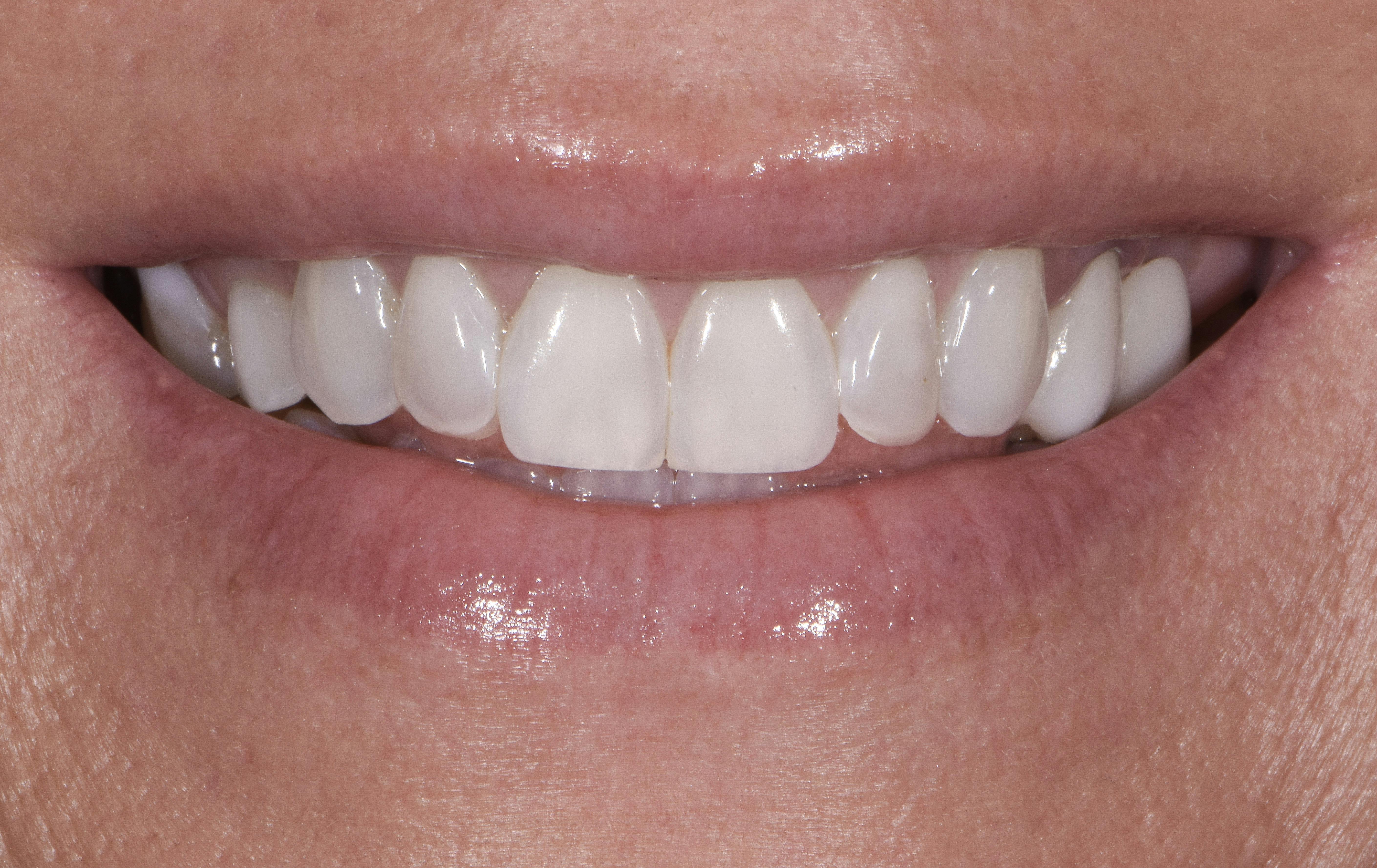 Before & After Photos | Charleston Center for Cosmetic and Restorative Dentistry - Bridges - Patient 1 - Before Procedure