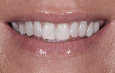 Porcelain Veneers Before & After Gallery - Patient 141772 - Image 1