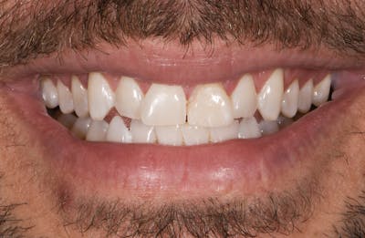 Porcelain Veneers Before & After Gallery - Patient 417547 - Image 1