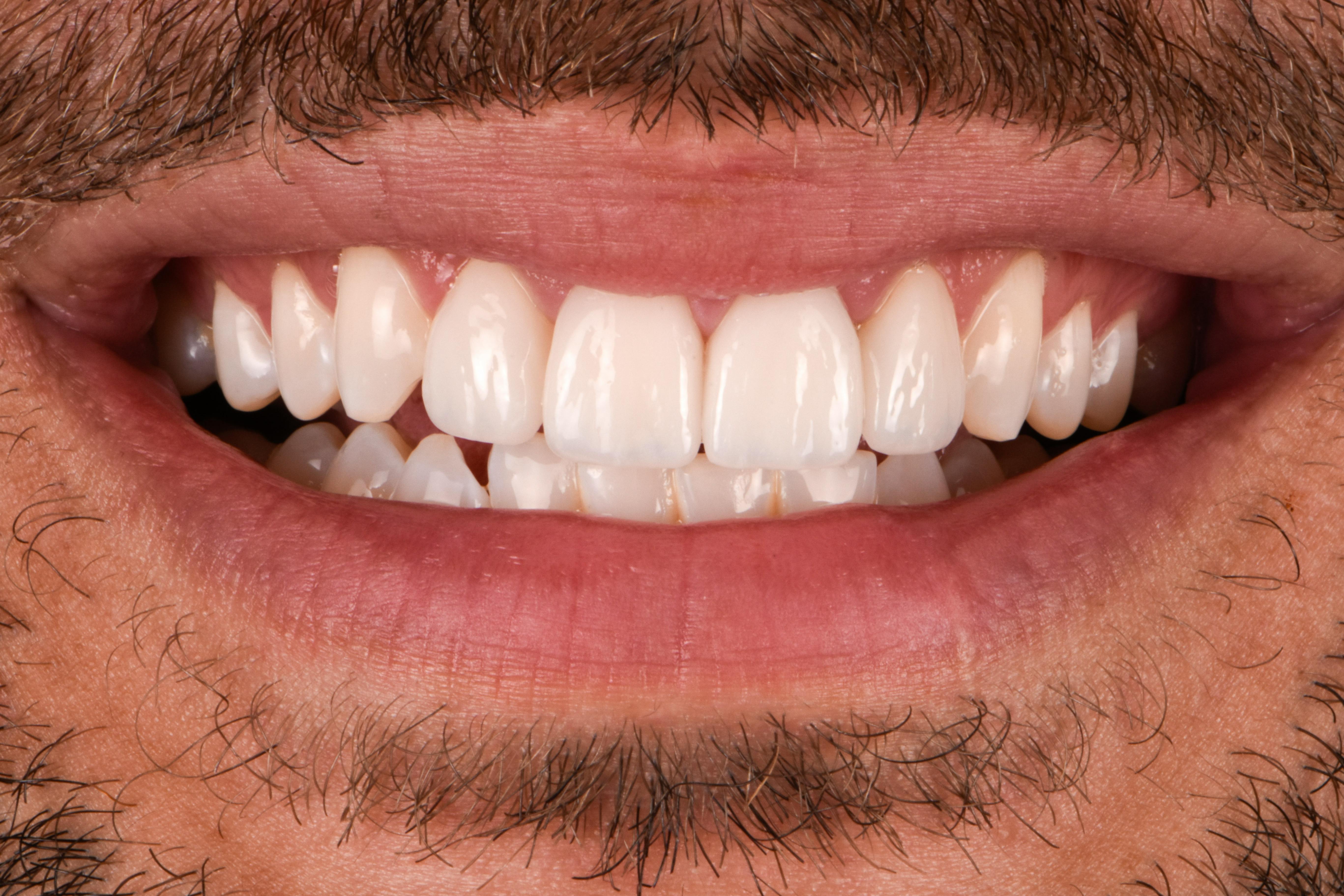 Before & After Photos | Charleston Center for Cosmetic and Restorative Dentistry - Porcelain Veneers - Patient 12 - After Procedure