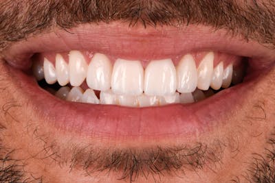 Porcelain Veneers Before & After Gallery - Patient 417547 - Image 2