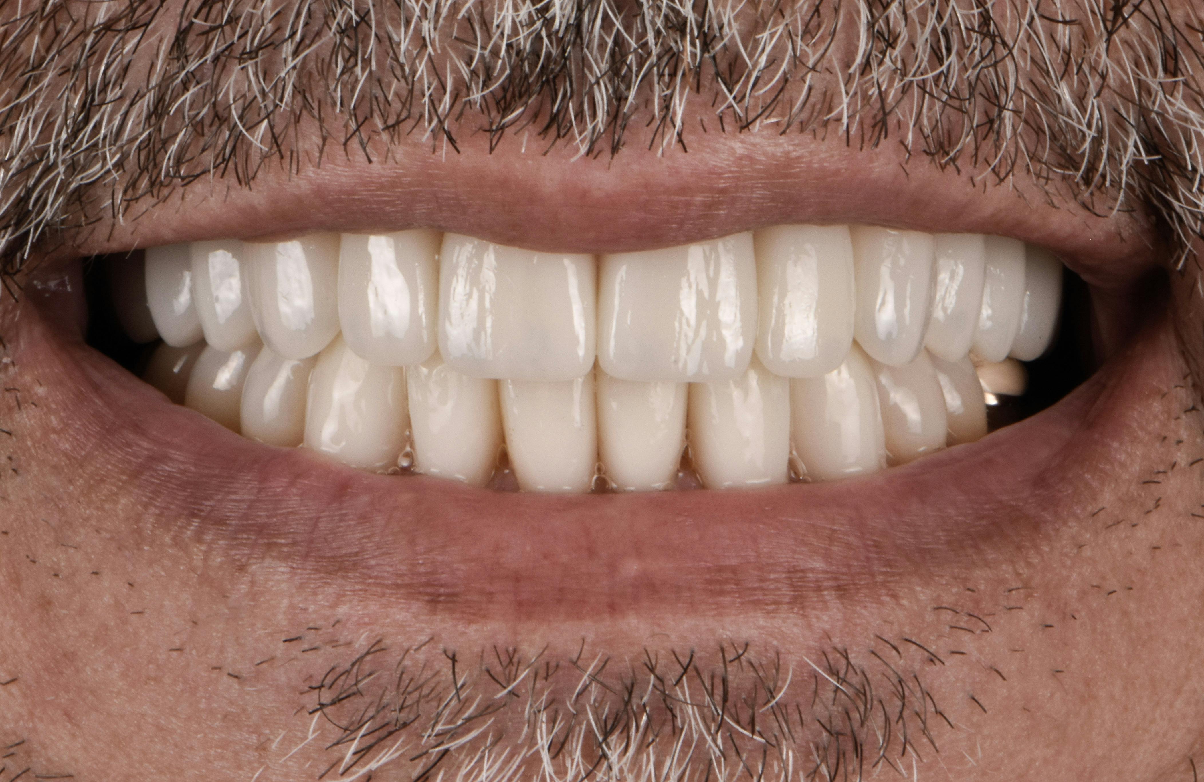 Before & After Photos | Charleston Center for Cosmetic and Restorative Dentistry - Full Mouth Restoration - Patient 1 - After Procedure