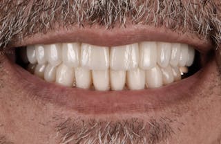 Full Mouth Restoration Before & After Gallery - Patient 241308 - Image 2