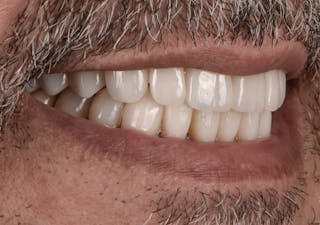Full Mouth Restoration Before & After Gallery - Patient 241308 - Image 4